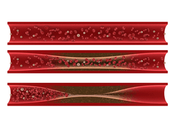 Aderverkalking tegengaan | artherosclerose